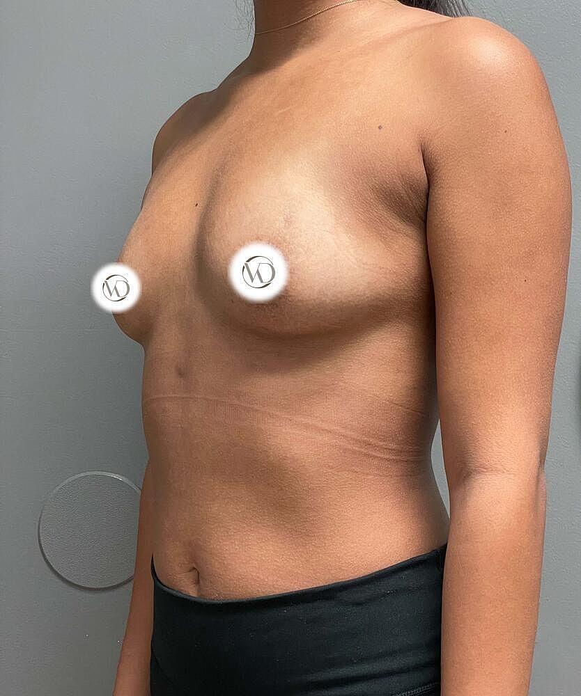 Breast Augmentation Before & After