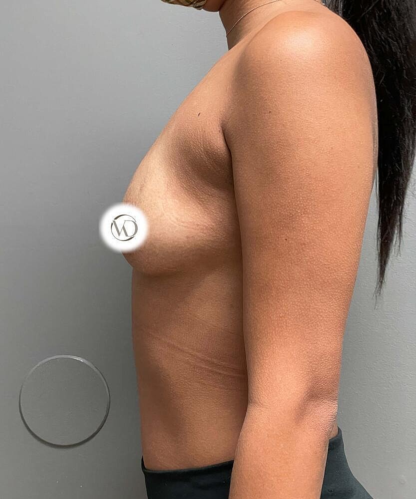 Breast Augmentation Before & After