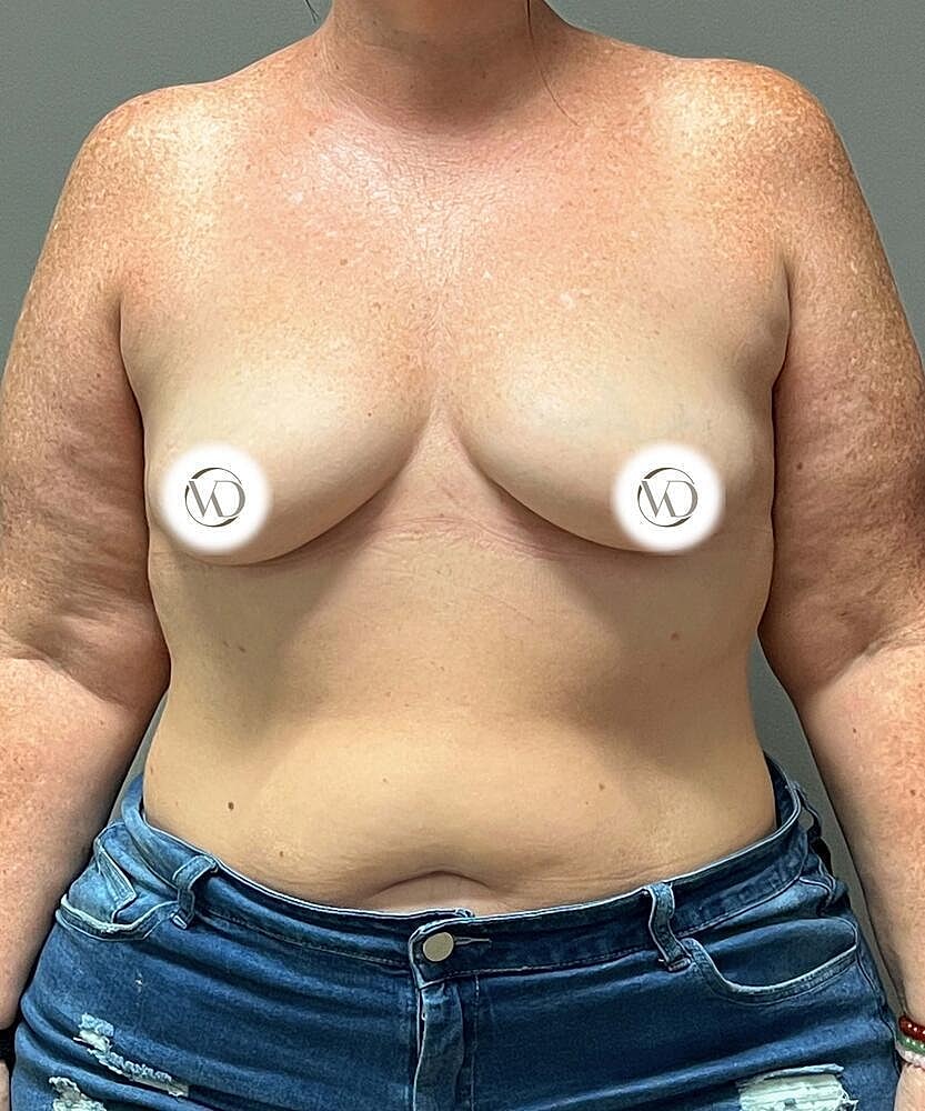 Breast Augmentation Before & After