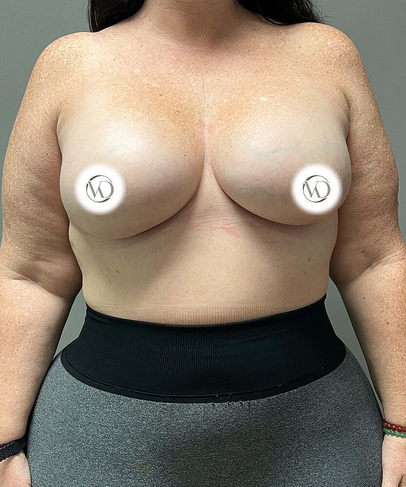Breast Augmentation Before & After
