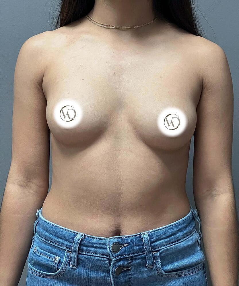 Breast Augmentation Before & After
