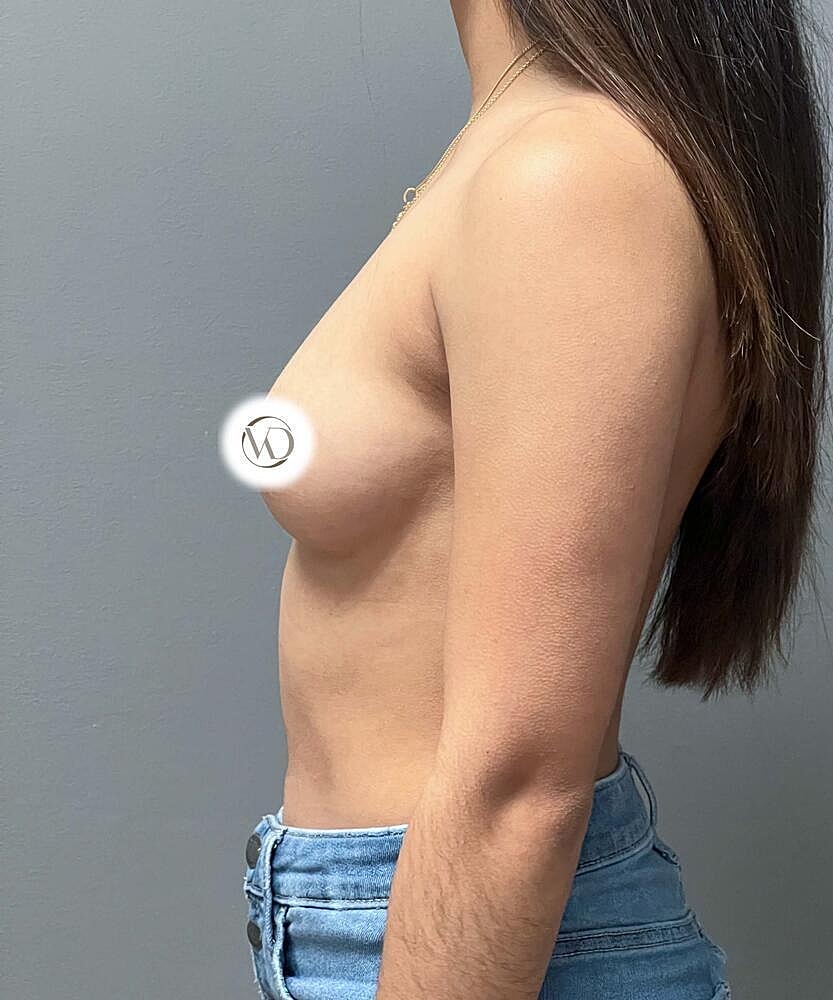 Breast Augmentation Before & After