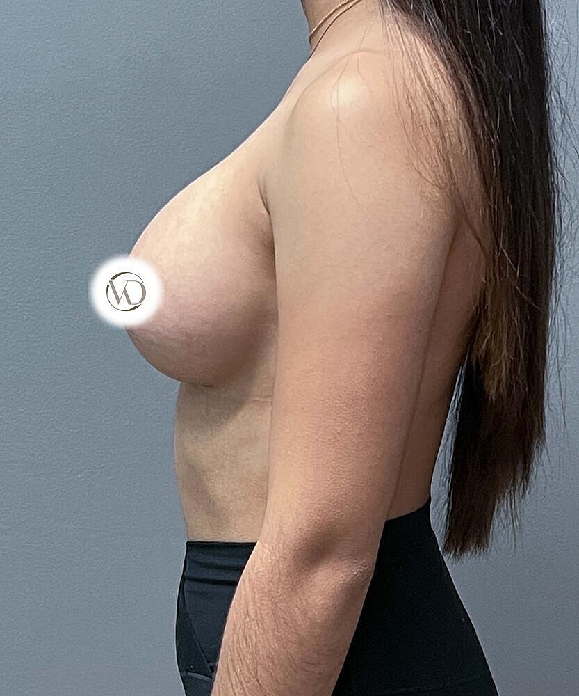 Breast Augmentation Before & After
