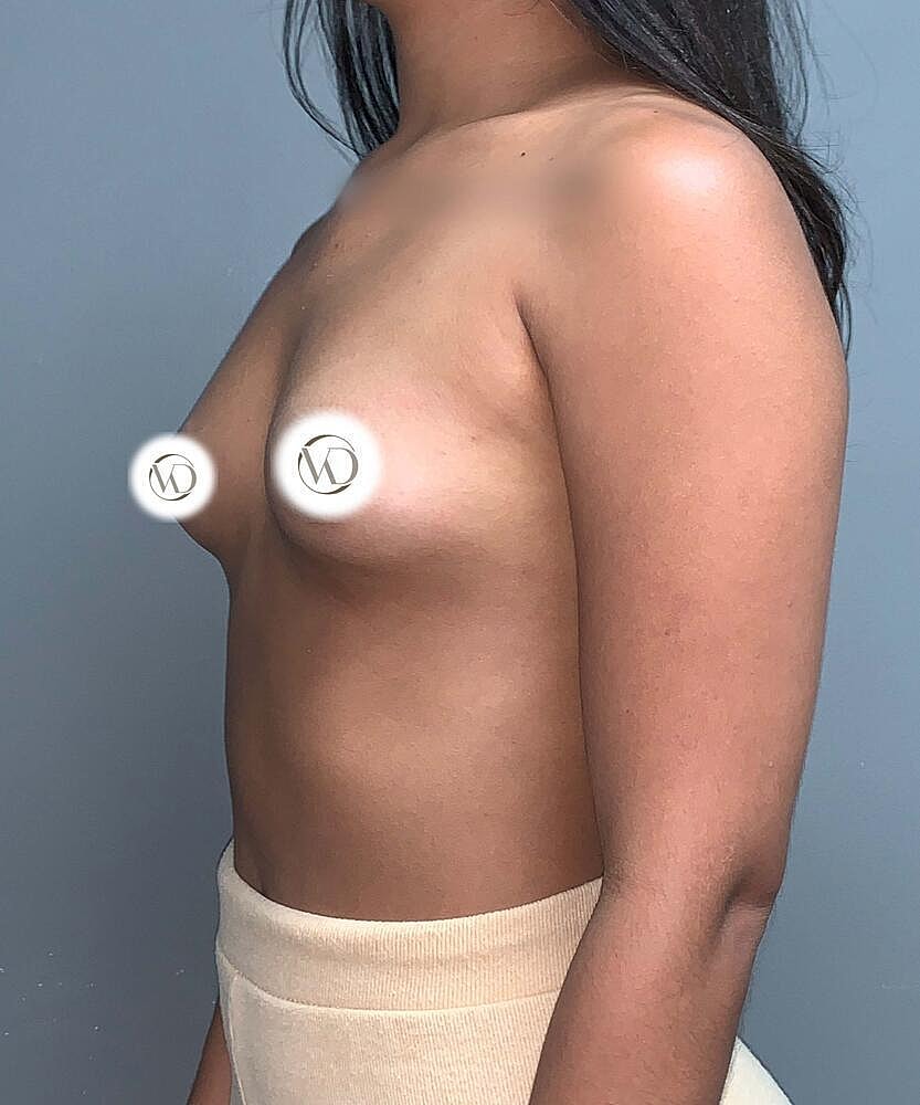 Breast Augmentation Before & After