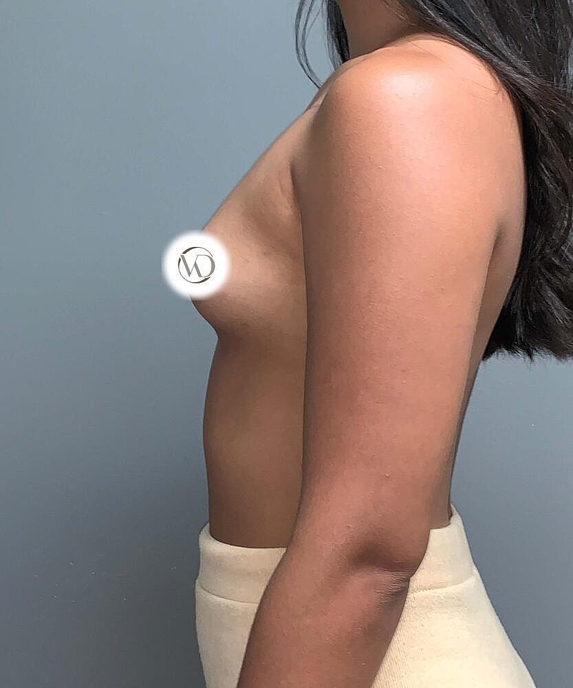 Breast Augmentation Before & After