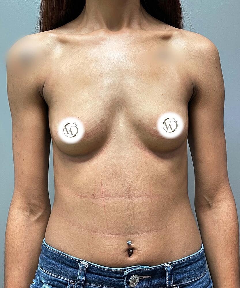 Breast Augmentation Before & After