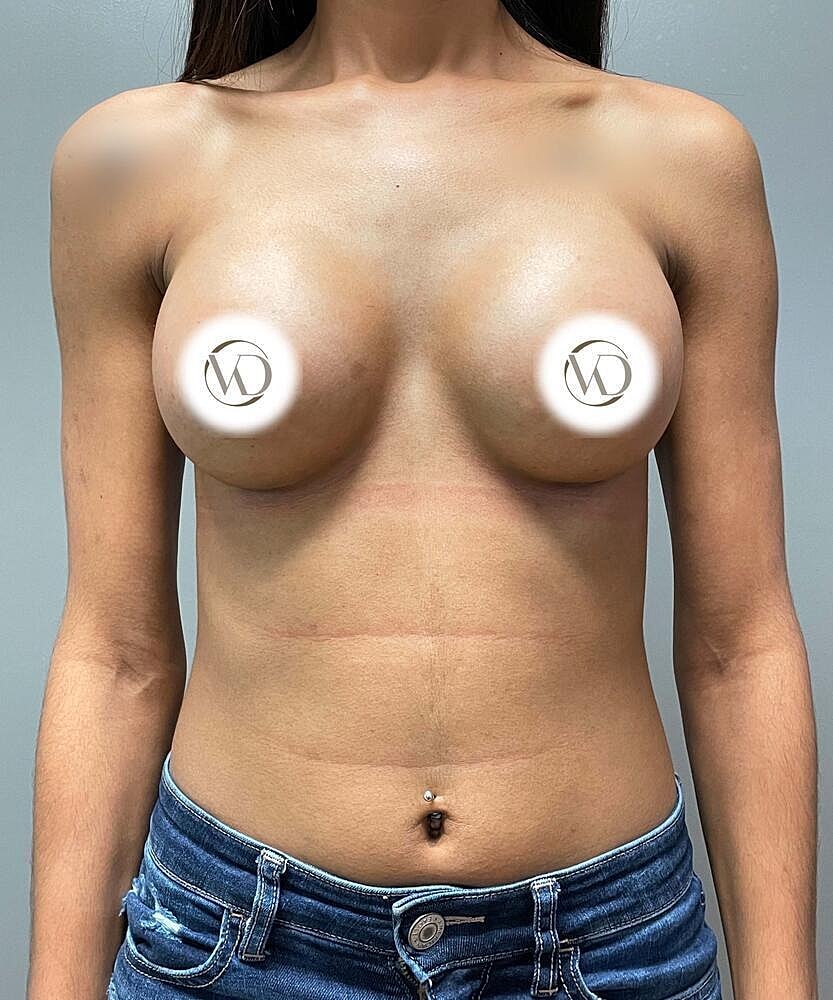 Breast Augmentation Before & After