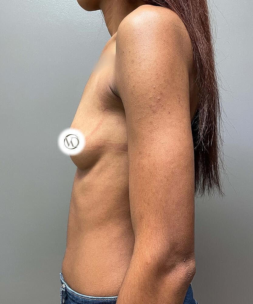 Breast Augmentation Before & After