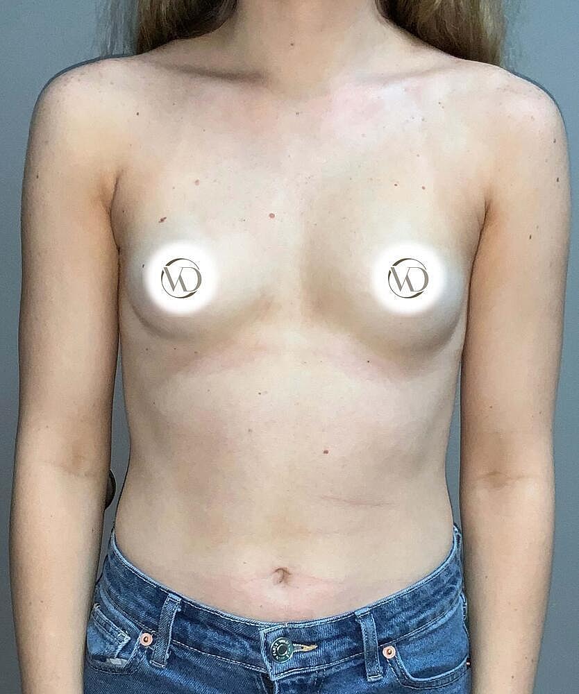 Breast Augmentation Before & After