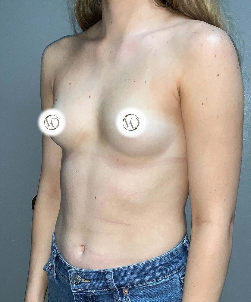 Breast Augmentation Before & After