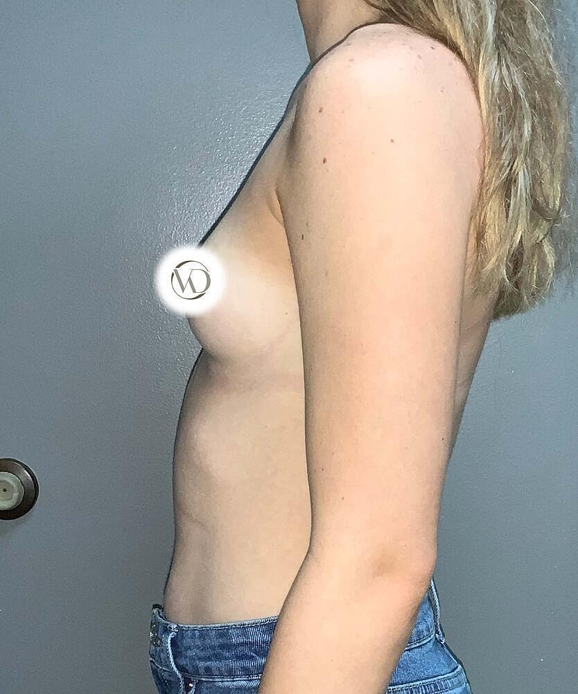 Breast Augmentation Before & After