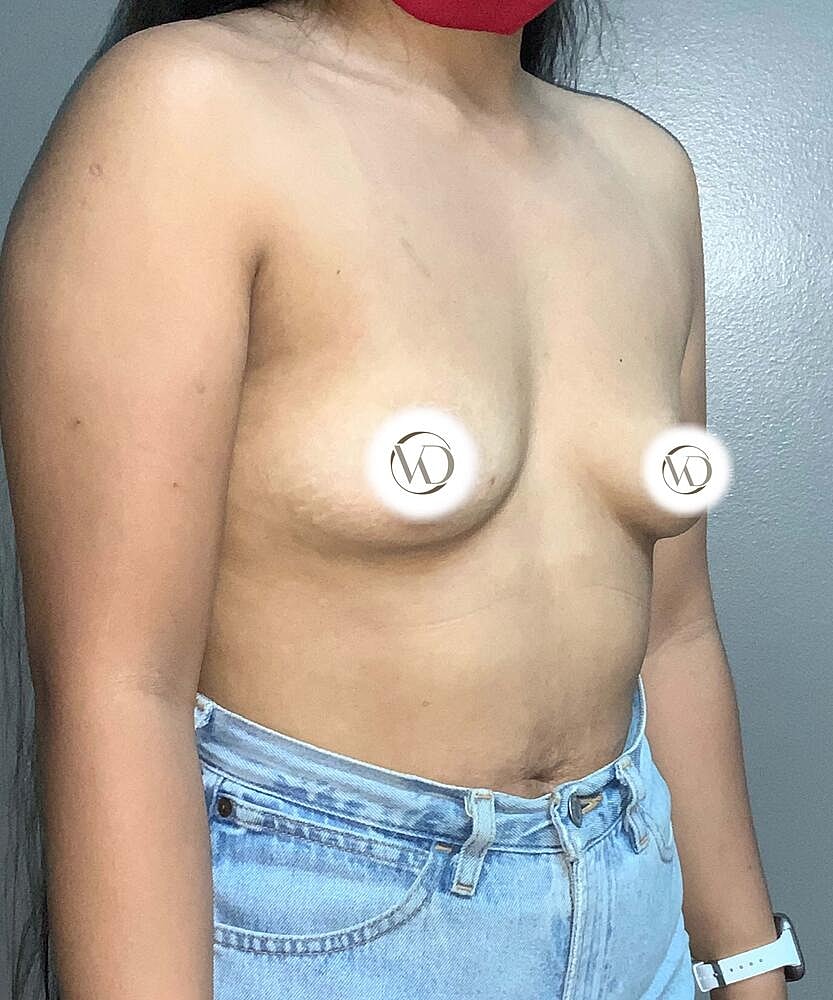 Breast Augmentation Before & After