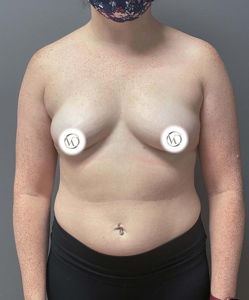 Breast Augmentation Before & After