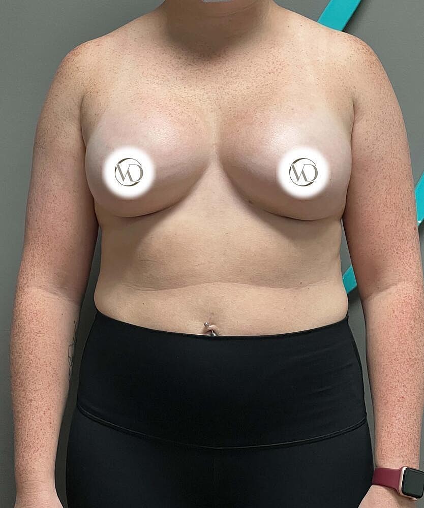 Breast Augmentation Before & After