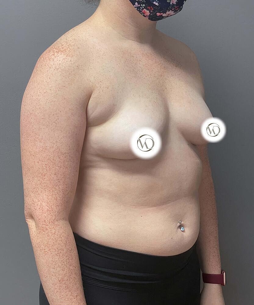 Breast Augmentation Before & After