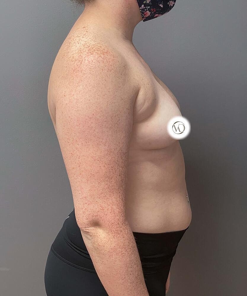 Breast Augmentation Before & After