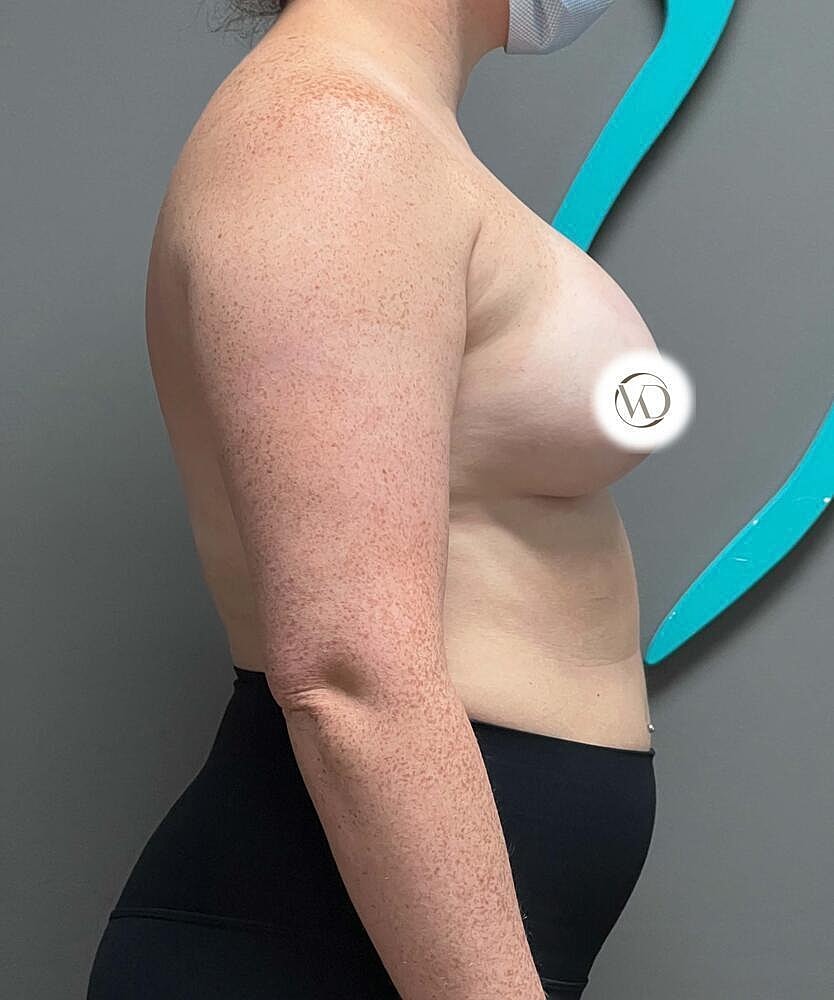 Breast Augmentation Before & After