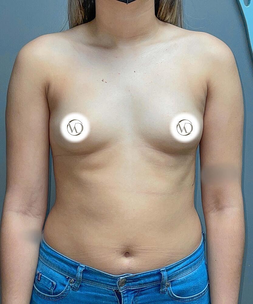 Breast Augmentation Before & After