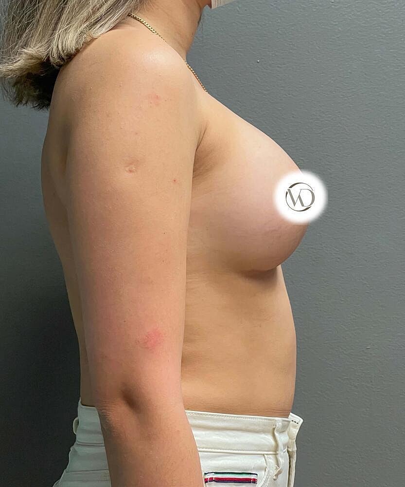 Breast Augmentation Before & After