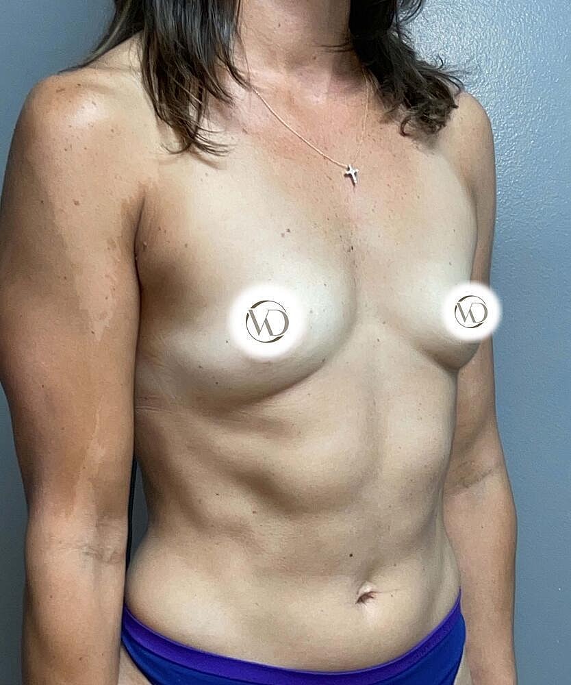 Breast Augmentation Before & After