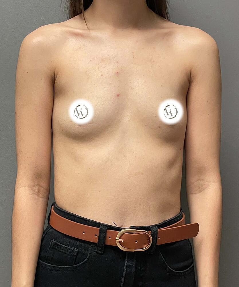 Breast Augmentation Before & After