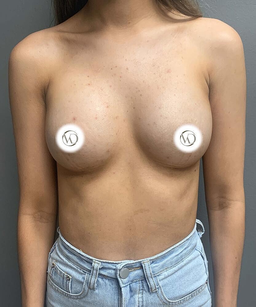 Breast Augmentation Before & After