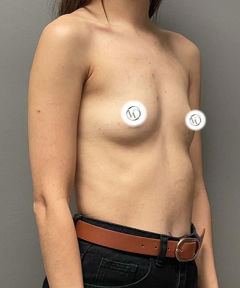 Breast Augmentation Before & After