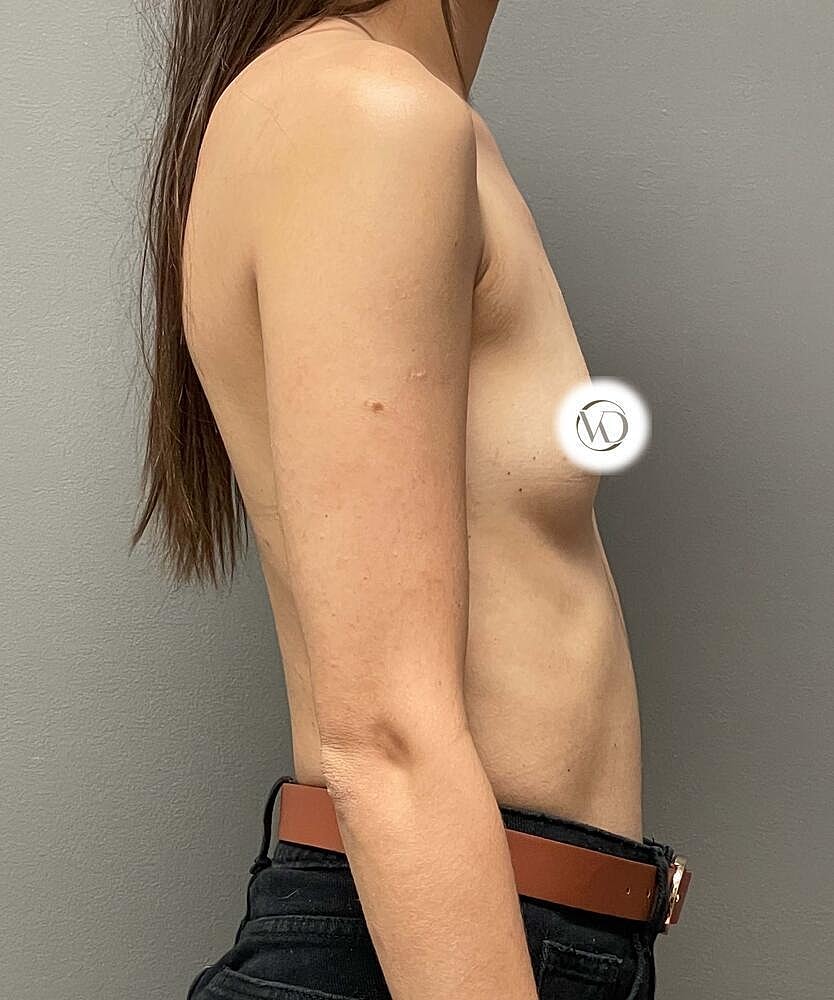 Breast Augmentation Before & After