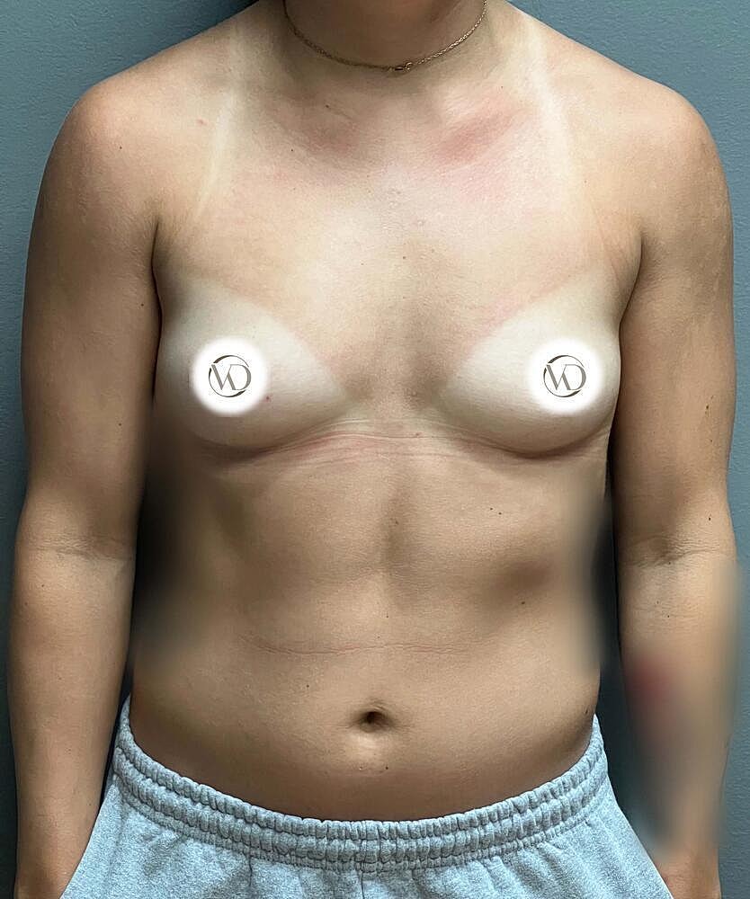 Breast Augmentation Before & After