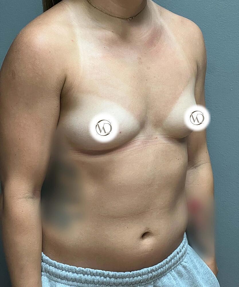 Breast Augmentation Before & After
