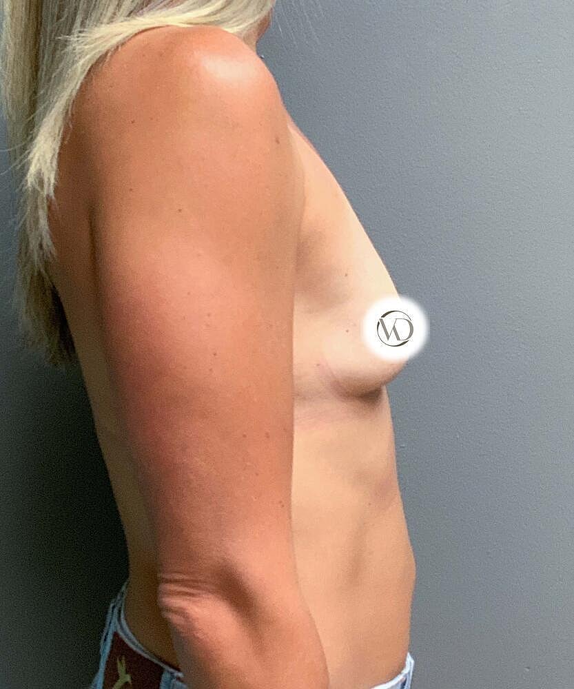 Breast Augmentation Before & After