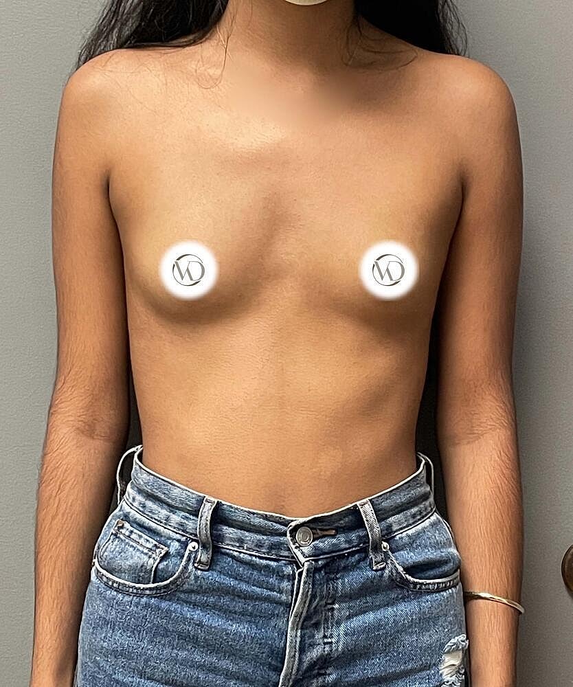Breast Augmentation Before & After