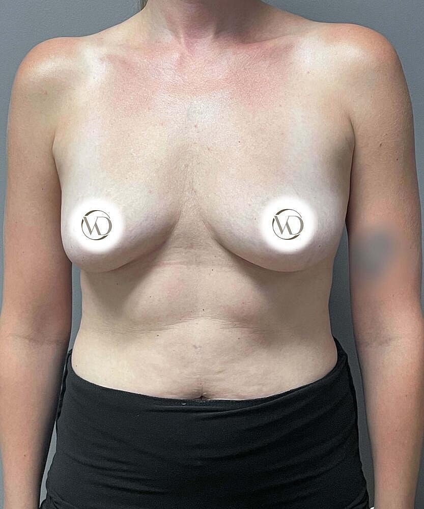 Breast Augmentation Before & After