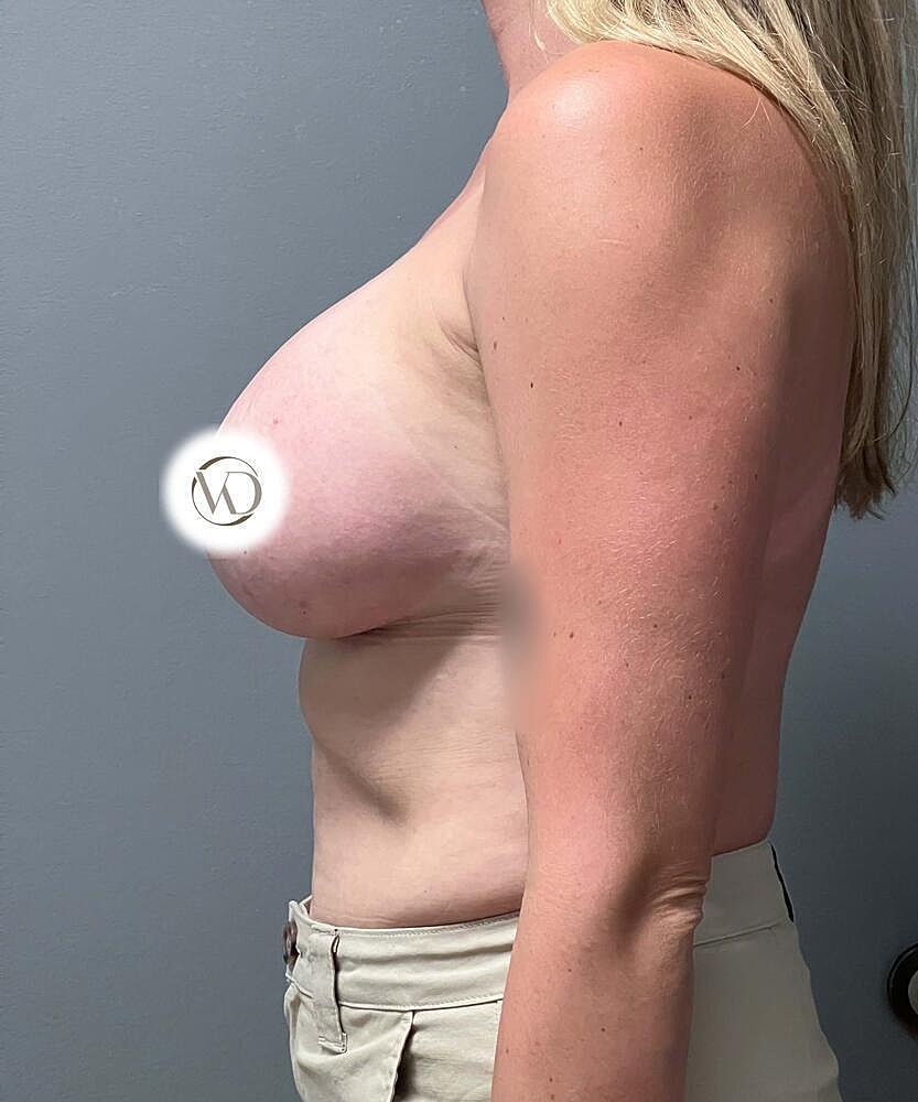Breast Augmentation Before & After