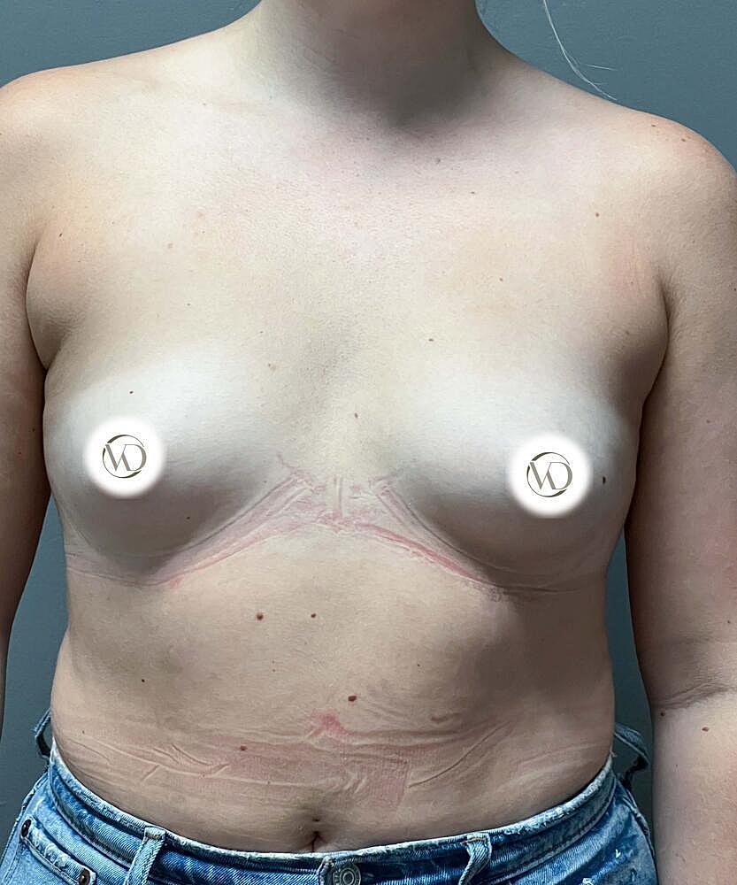 Breast Augmentation Before & After