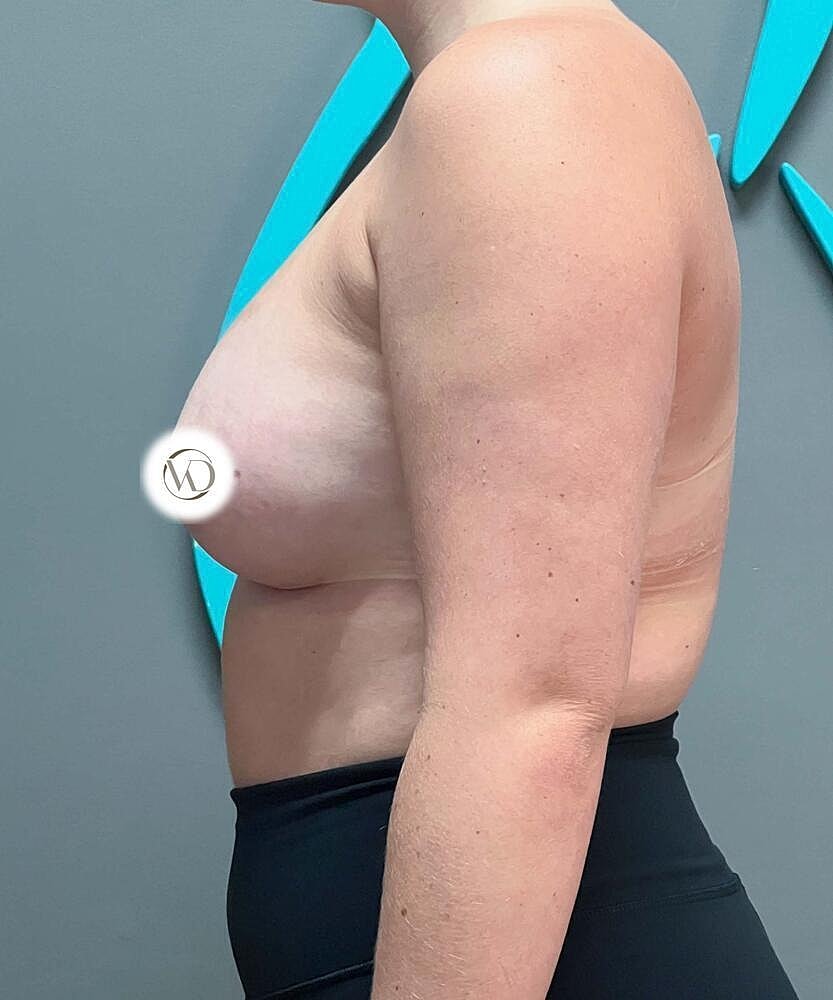 Breast Augmentation Before & After