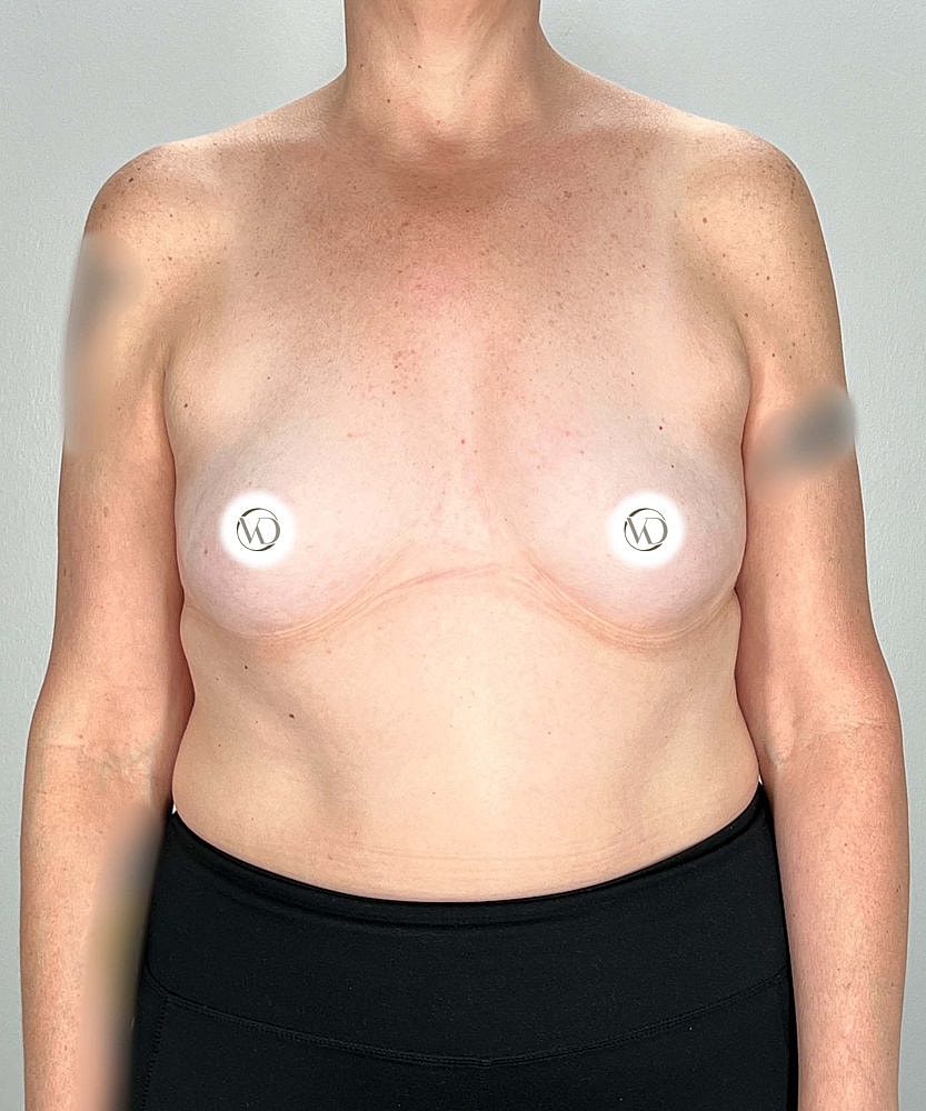 Breast Augmentation Before & After