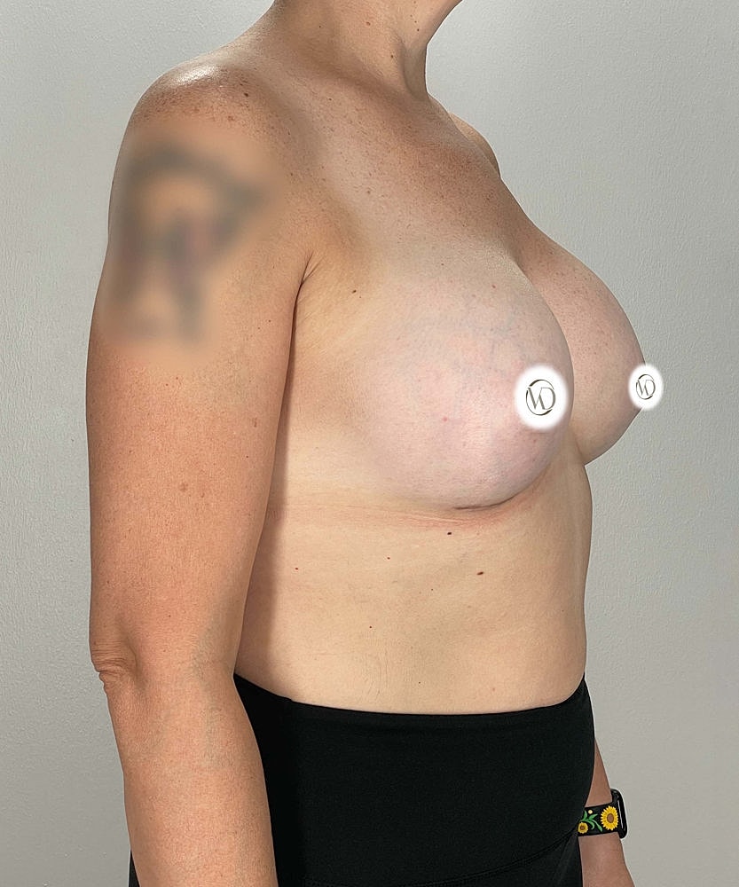Breast Augmentation Before & After