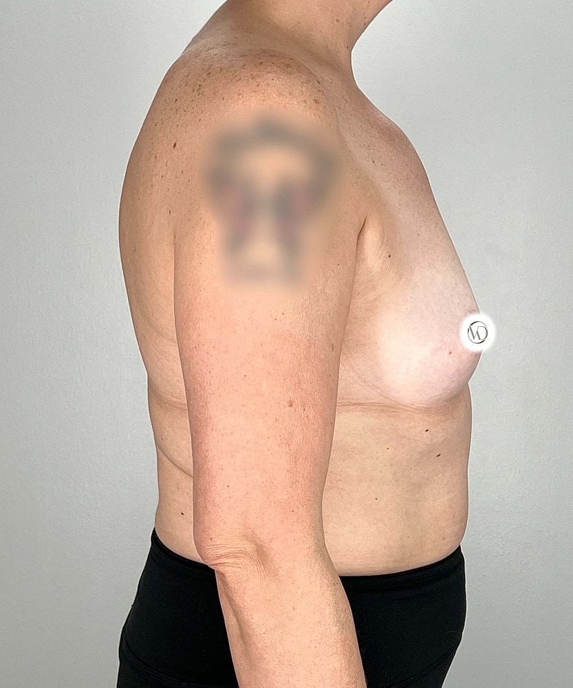 Breast Augmentation Before & After