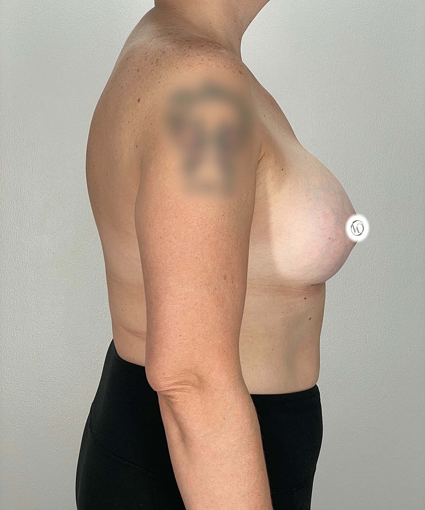 Breast Augmentation Before & After