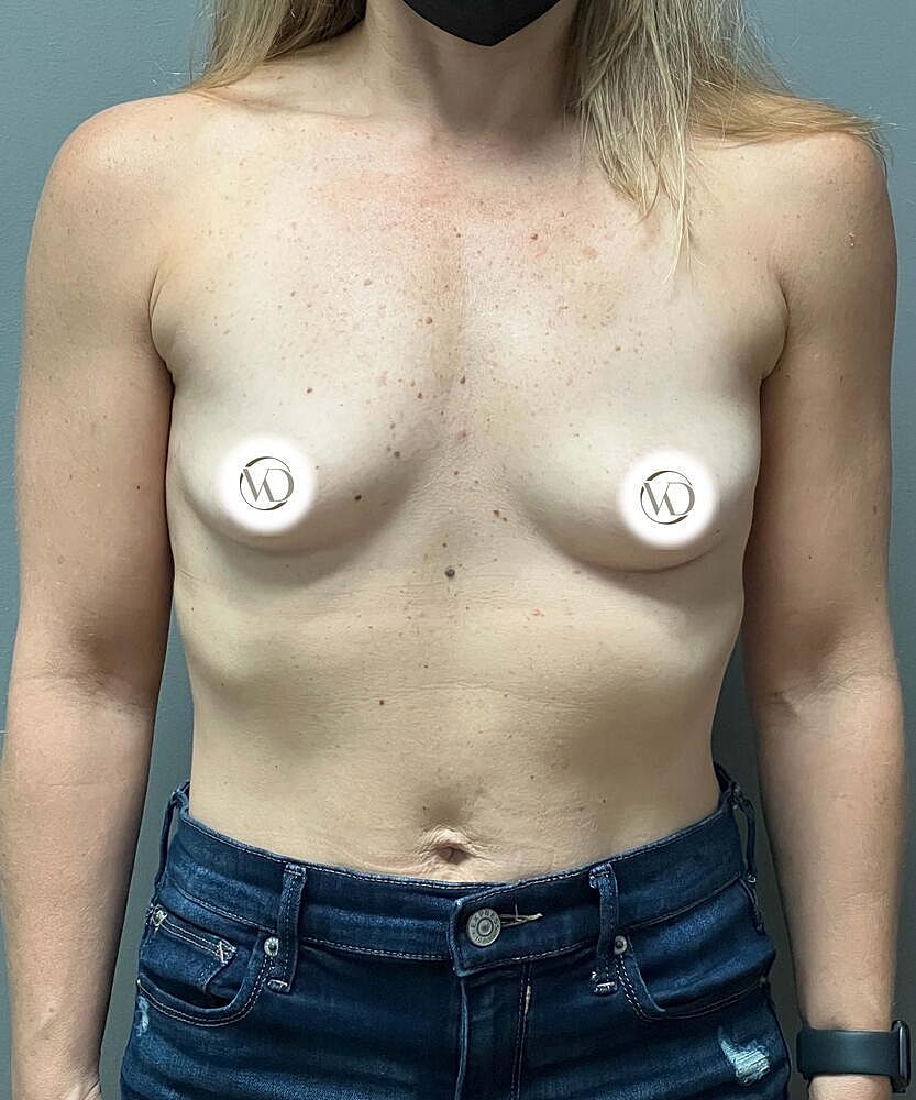 Breast Augmentation Before & After