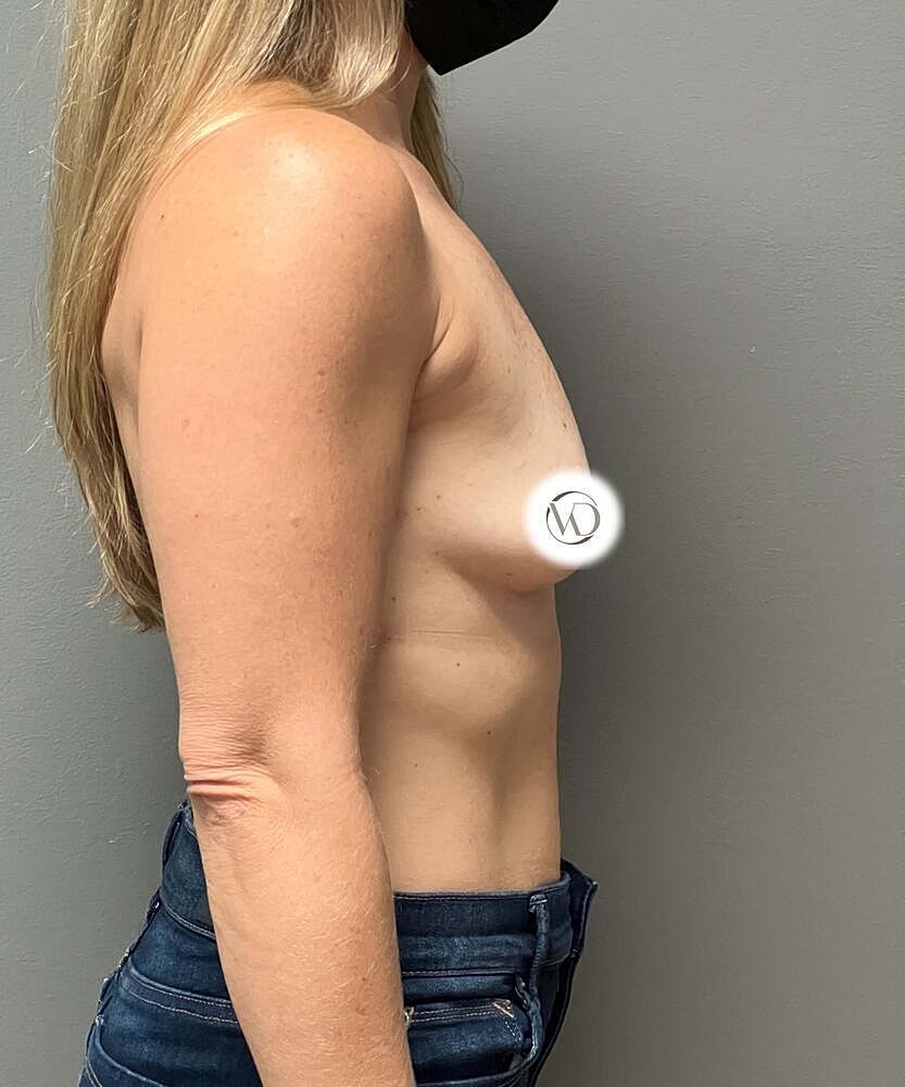 Breast Augmentation Before & After