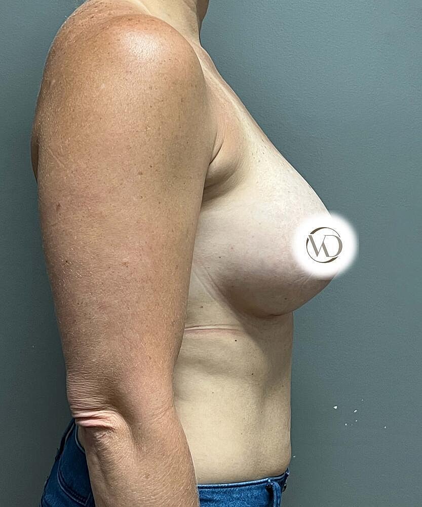 Breast Augmentation Before & After
