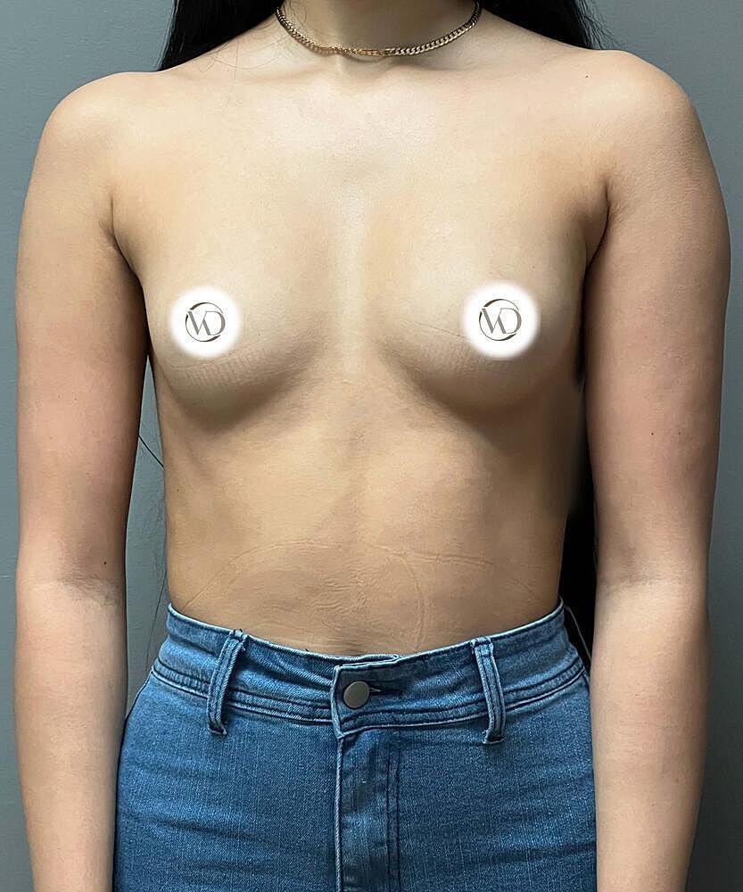 Breast Augmentation Before & After