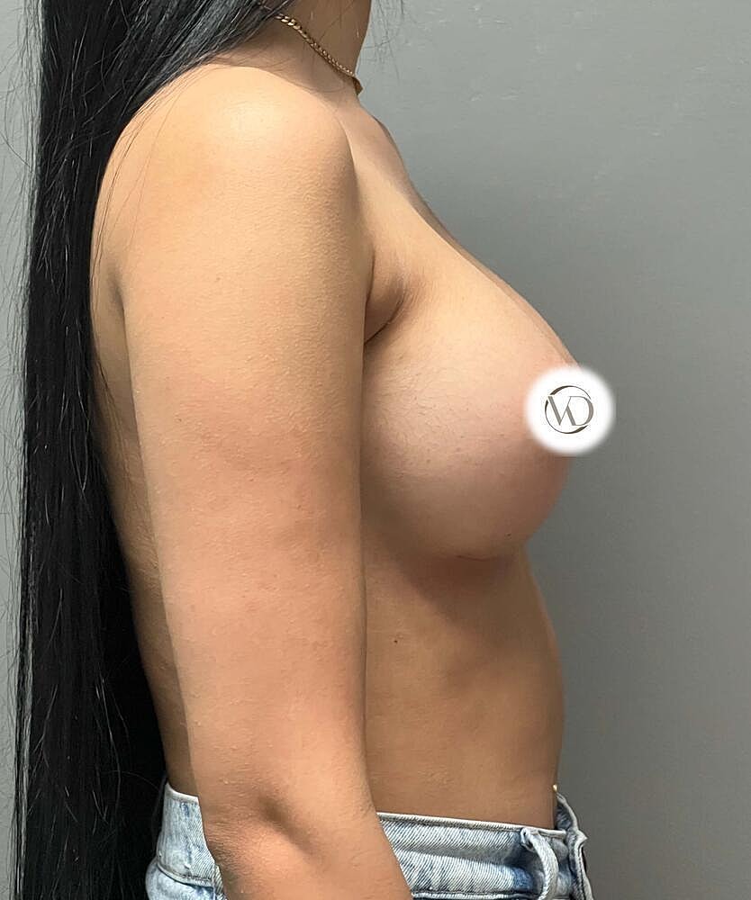 Breast Augmentation Before & After