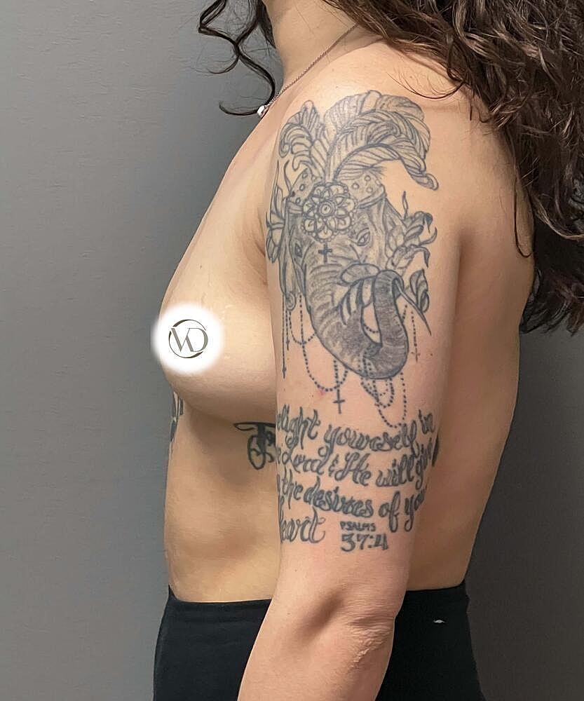 Breast Augmentation Before & After