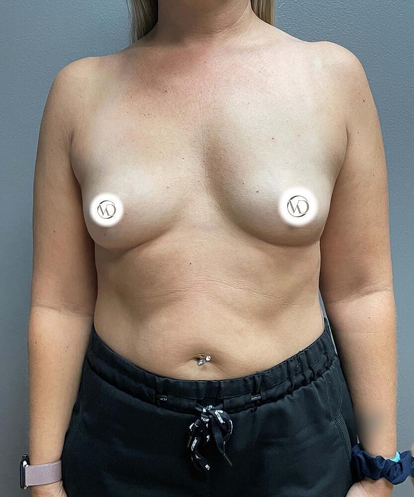 Breast Augmentation Before & After