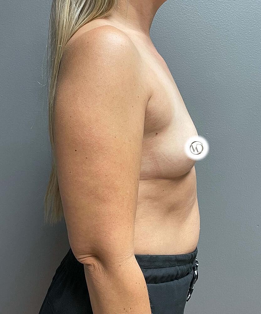 Breast Augmentation Before & After