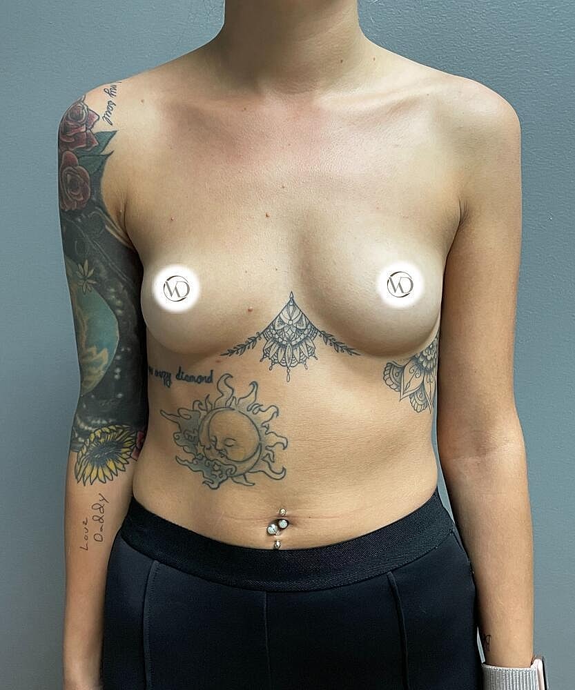 Breast Augmentation Before & After