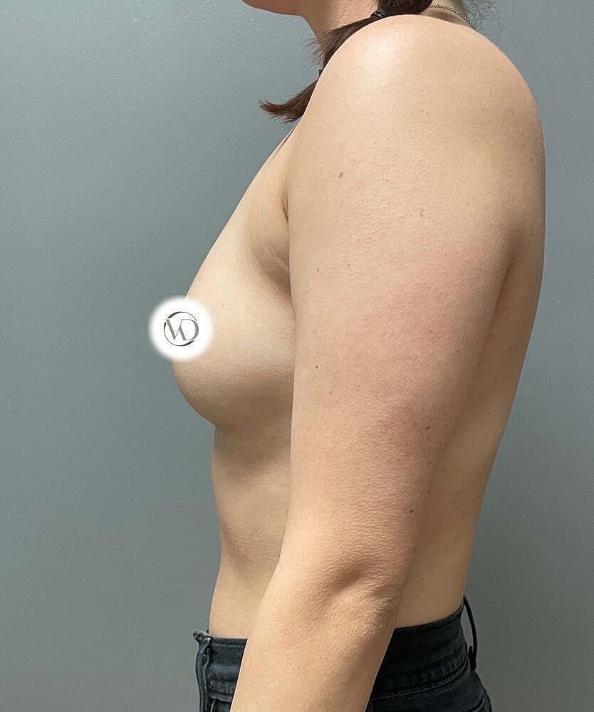 Breast Augmentation Before & After